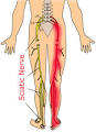Sciatic Nerve Treatment