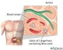 Diabetes - type 1 - Causes