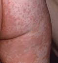Measles Photos - Pictures of Measles Rash 