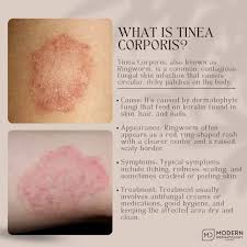 Image result for tinea corporis