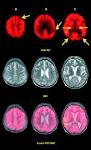 <b>Niemann</b>-<b>Pick type C disease</b> in