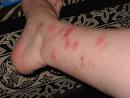 bed bug bites pictures, bedbug bites: what do they look like ...