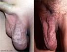<b>Varicocele</b>