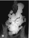 barium study - definition of barium study in the Medical ...