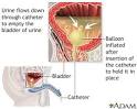 <b>Bladder</b> catheterization, male - Acute bilateral <b>obstructive</b>