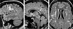 <b>Lyme Neuroborreliosis</b>: