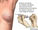 <b>Biopsia</b> con aguja del seno
