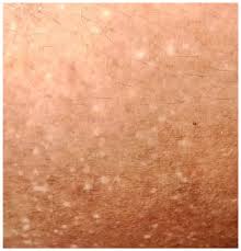 Attēlu rezultāti vaicājumam “Diderma umbilicatum young”