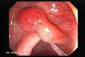 Polyps, El Salvador Atlas of Gastrointestinal Video Endoscopy