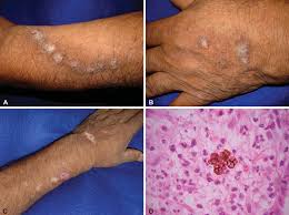 Attēlu rezultāti vaicājumam “Colloderma sp.”