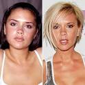  Victoria Beckham botox | Botox Celebrities