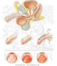 Diverticula of Urethra, Accessory Urethral Channels, Verumontanum ...