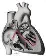 Corazón estirpado de una
