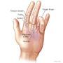 q=q%3Dhttps://www.mayoclinic.org/diseases-conditions/trigger-finger/care-at-mayo-clinic/mac-20365618 from sportsmedicine.mayoclinic.org