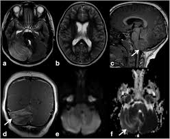 Image result for pthc