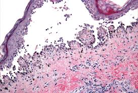 Attēlu rezultāti vaicājumam “Pemphigus borealis”