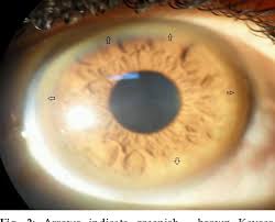 Kuvahaun tulos haulle Kayser-Fleischer