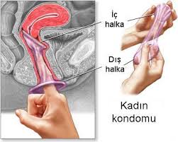 Kadın Prezervatifi – Kondom