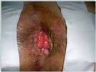 Hemorrhoidal prolapse &amp; PPH procedure | Unbounded Medicine