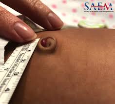 Attēlu rezultāti vaicājumam “Diderma umbilicatum young”