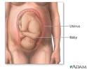 Labor and delivery - Breech - Series