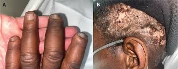 Attēlu rezultāti vaicājumam “Scleroderma”