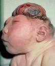 ANENCEPHALY. Causes, symptoms, treatment ANENCEPHALY