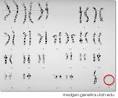 Turner Syndrome