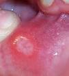Aphthous ulcer - Wikipedia, the free encyclopedia