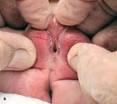 Hermaphrodite Infant | Consultant for Pediatricians