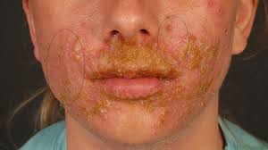 Attēlu rezultāti vaicājumam “Diderma simplex sessile”