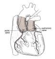 Aortic Valve Surgery: Ross Procedure