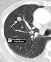 <b>Coin Lesion</b>-a solitary