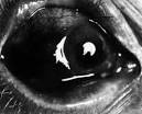 severe than that found in <b>scleral disease</b> and is accompanied by fever,
