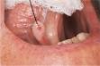<b>papilloma</b> - definition of <b>papilloma</b> in the Medical dictionary - by
