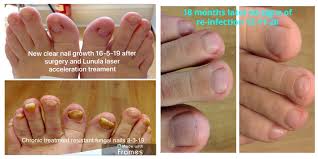 Image result for lunula nail