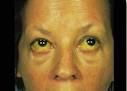 Jaundiced Eyes