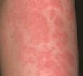 food allergy blood test