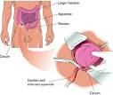 Appendectomy | Nursing Crib