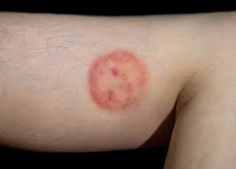 Image result for tinea corporis