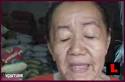 Nguyen Thi Phuong Face Suffers Mastocytosis Aging - Nguyen-Thi-Phuong