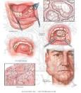 Benign Tumors of Oral Cavity - Netter Medical Artwork