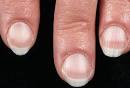 Slideshow: What Your Nails Say About Your Health