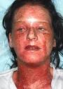 from allergic reaction to