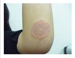 Image result for tinea corporis