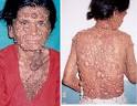 neurofibromatosis patient 2 Horrible Skin Disease Bubble Man Mohammad Umar ... - neurofibromatosis-patient-2