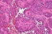 Angiosarcoma - Wikipedia, the free encyclopedia