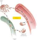 in <b>focal infection</b>).