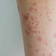 Image result for bed bugs