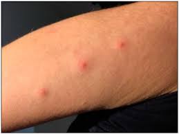 Image result for bed bug bites